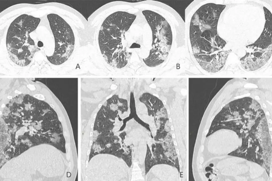 44yaşında corona virüsten hayatını kaybeden kişinin  akciğer röntgen filmleri virüsün verdiği zararıortaya çıkardı 2