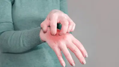 Google aramalarında yeni trend: Uyuz hastalığı