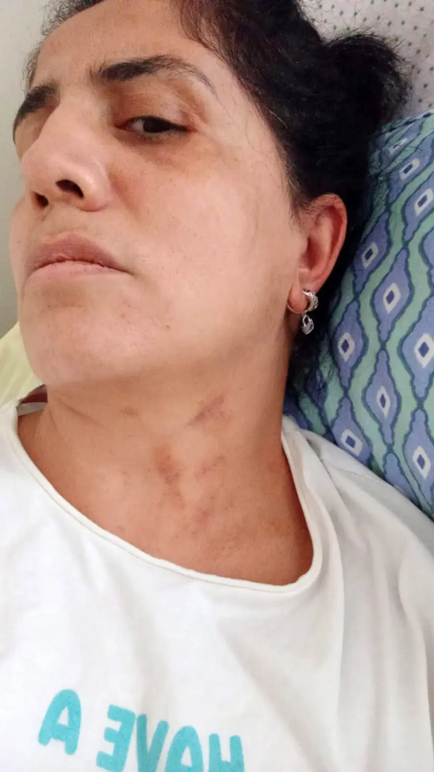 Ameliyatta karnında unuttukları iğne kabusu oldu! Eşi, bebek sahibi olamadığı için dövdü 1