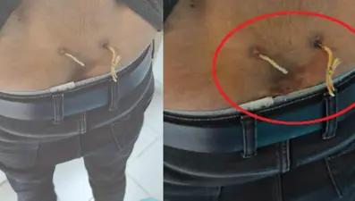 ‘Alternatif tıp’ adı altında işkence: Çamaşır ipiyle bel tedavisi