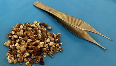 Hastanın iki böbreğinden 300'ün üzerinde taş çıktı: ''Hatırası var'' deyip eve götürdü