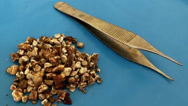 Hastanın iki böbreğinden 300'ün üzerinde taş çıktı: ''Hatırası var'' deyip eve götürdü