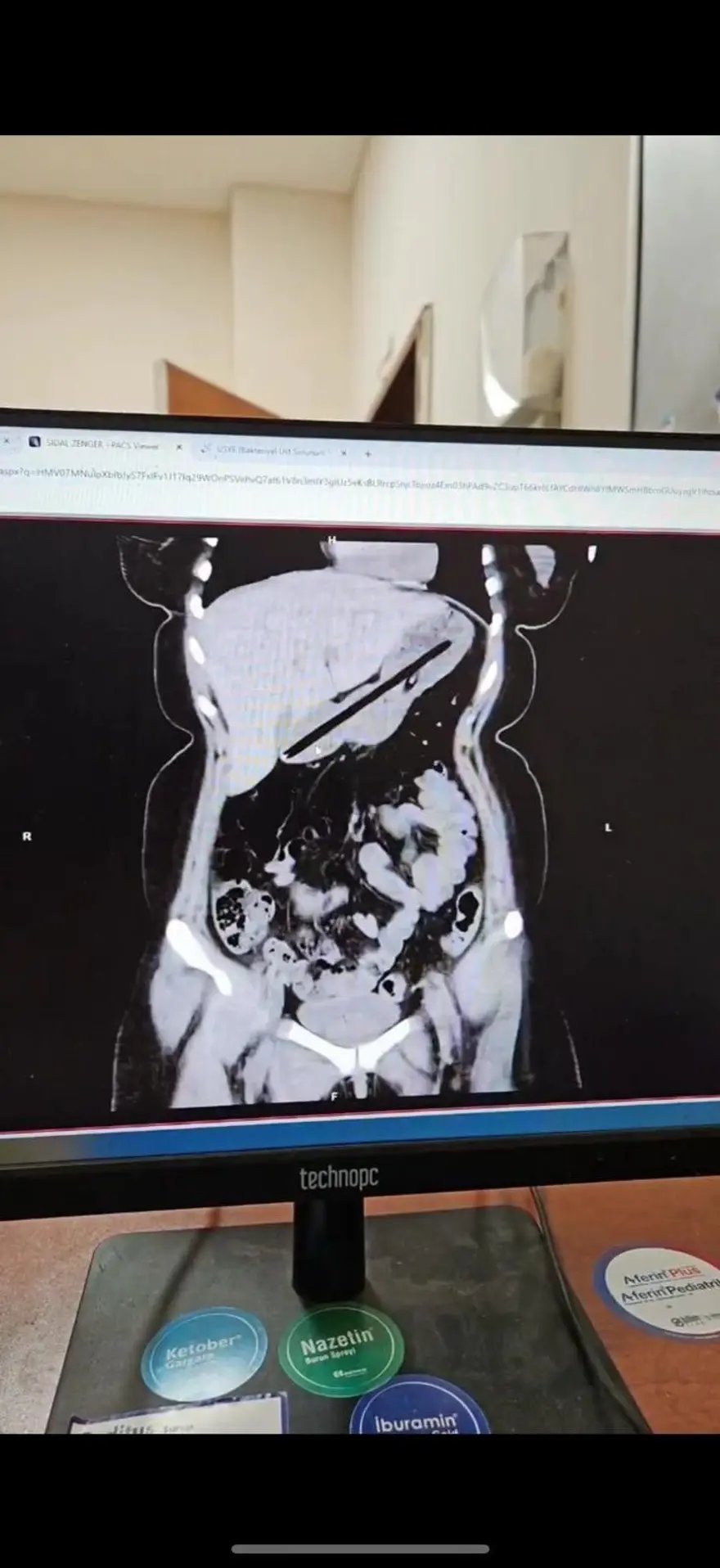 22 yaşındaki kadının midesinden 2 kalem çıkarıldı 2