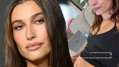 Hailey Bieber: Yumurtalık kistim var