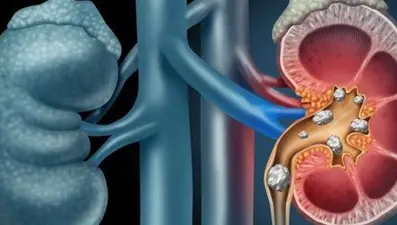 Böbrek taşı neden olur?