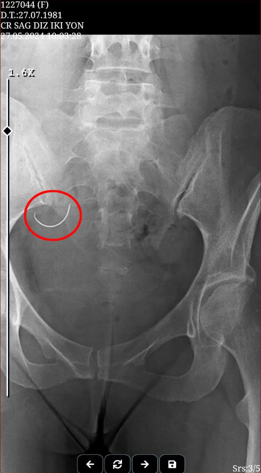 Ameliyatta karnında unuttukları iğne kabusu oldu! Eşi, bebek sahibi olamadığı için dövdü 2