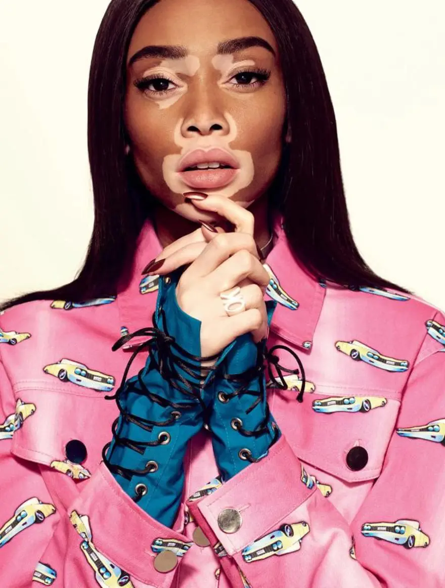 Vitiligolu model Winnie Harlow: Sizin gibi beynim ve iskeletim var 1