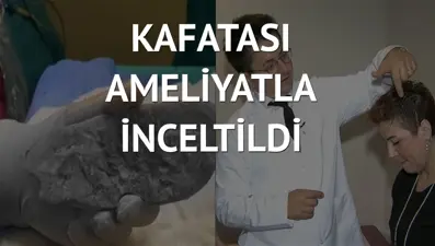 Geçmeyen baş ağrılarının nedeni kafatası kalınlaşması çıktı
