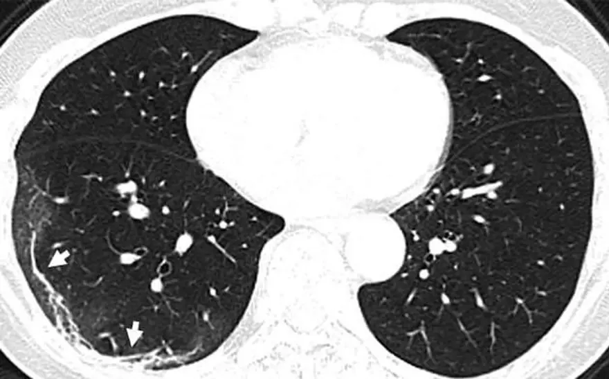 HAVA KESECİKLERİ DOLUYOR 1