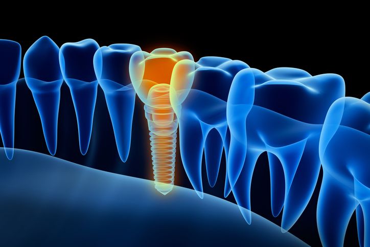 "Ucuz implantlar, bir süre sonra çene kemiğini eritir" (Uzman uyarısı)
