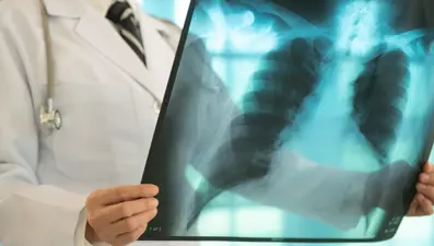 Sigara içmeyenlerde neden Akciğer kanseri görülüyor: 5 nedeni var