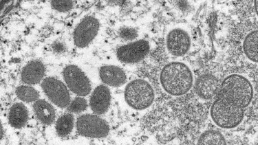 Maymun Çiçeği virüsü nedir, nasıl bulaşır? Maymun Çiçeği (Monkeypox) virüsünün belirtileri nelerdir, ölümcül mü, tedavisi var mı?