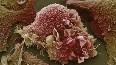 Melanomda erken tanı önemli