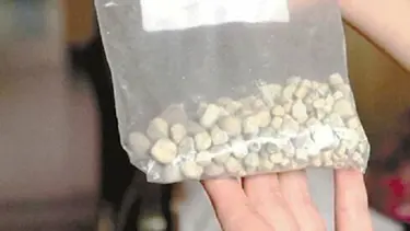 Böbreğinden 420 taş çıkarıldı