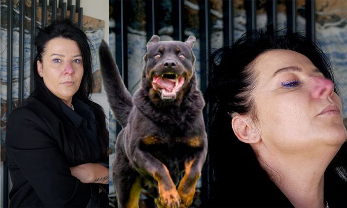 Bursa'da rottweiler saldırısı: Arkadaşının köpeği burnunu parçaladı