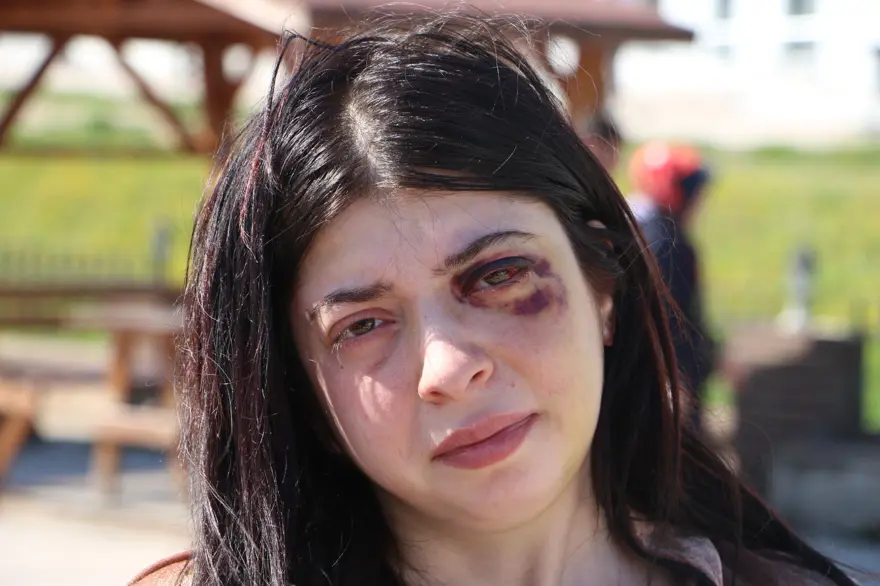 Sokak ortasında önce sözlü taciz sonra saldırı: Damla üç ay sadecesıvıyla beslenecek 4 Sokak ortasında önce sözlü taciz sonra saldırı: Damla üç ay sadecesıvıyla beslenecek 4