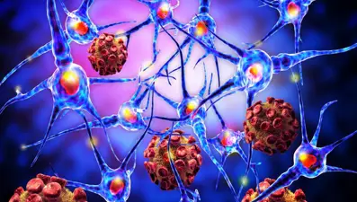 MS (Multipl Skleroz) erkeklerde daha şiddetli seyrediyor