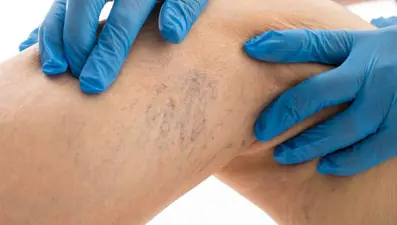 Varise EVTA yöntemi ile müdahale! (Yazın pıhtı riski artıyor)