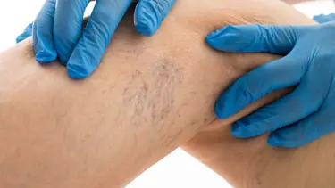 Varise EVTA yöntemi ile müdahale! (Yazın pıhtı riski artıyor)