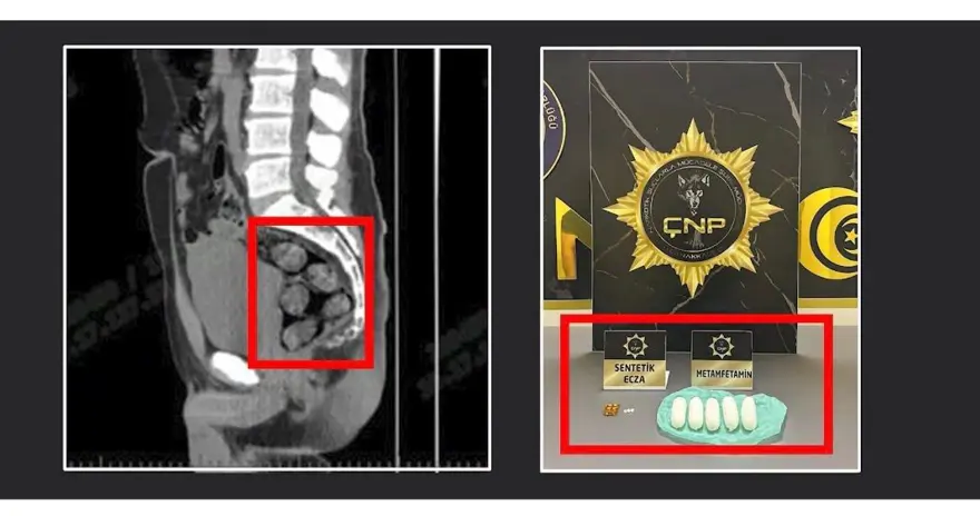 Tomografide şok eden görüntü: Midesinden çıkarıldı 