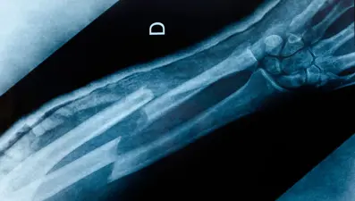 "Hiç kemiği kırılmamış" kişilerle ilgili üç tuhaf teori