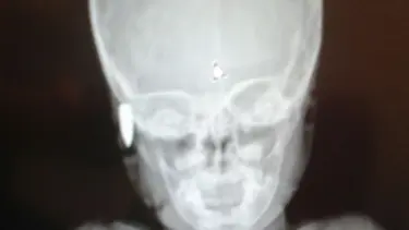 Balkonda oynayan çocuğun başına mermi isabet etti