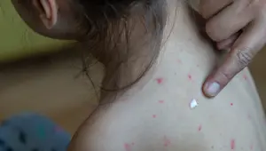 Kanada'da kızamık vakaları artıyor: "Kızamıktan arınmış ülke" statüsünü kaybetti