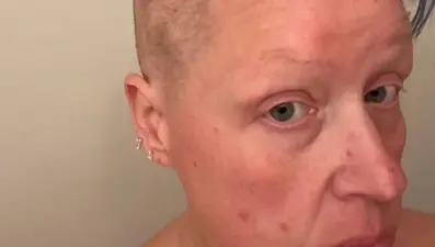 Saç koparma hastalığı yüzünden kel kaldı