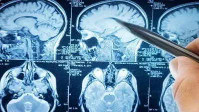 Felç riski sigara içenlerde 2,5 kat fazla (10 Mayıs Dünya İnme Önleme Günü)