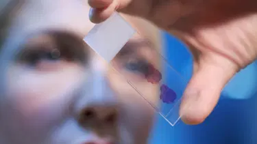 Kök hücre tedavisi kanserle mücadelede avantaj sağlayacak