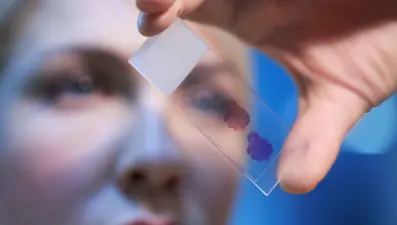 Kök hücre tedavisi kanserle mücadelede avantaj sağlayacak