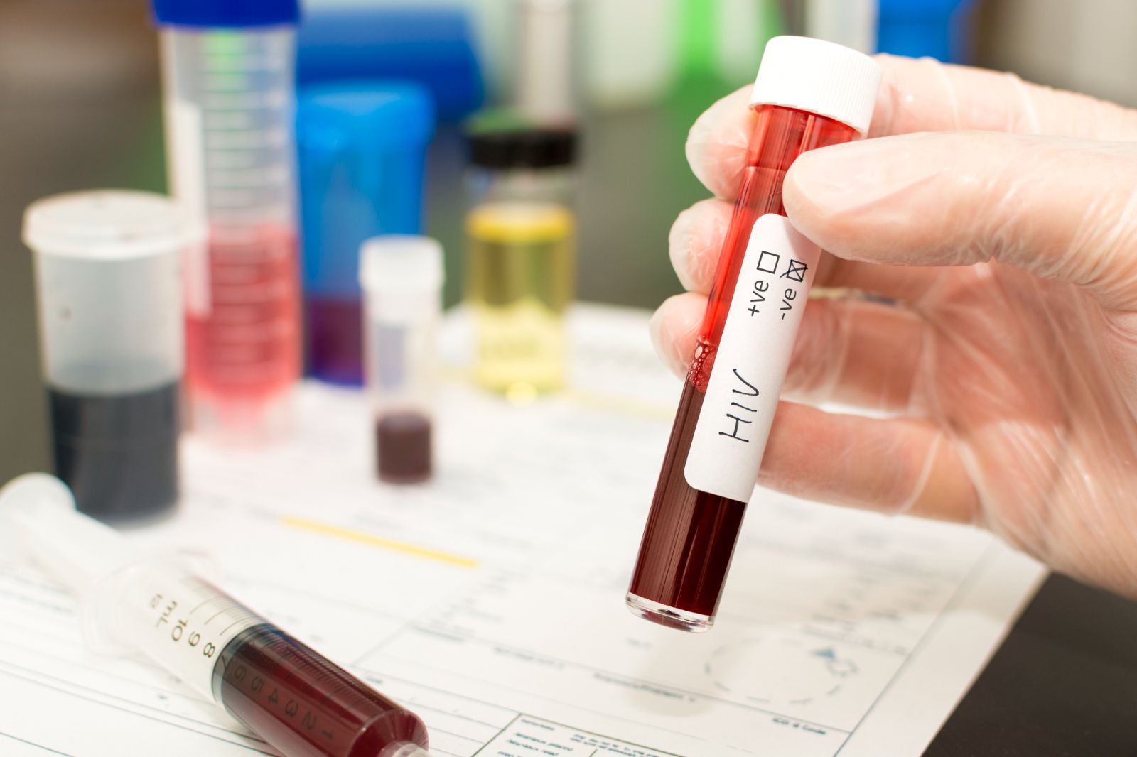 Türkiye'de HIV vakaları artıyor