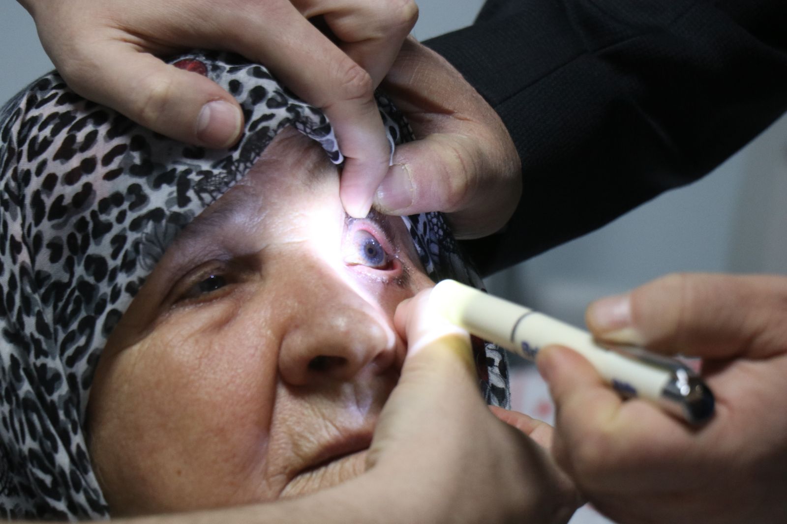 74 yaşındaki kadının karanlık dünyası, kornea nakliyle aydınlandı