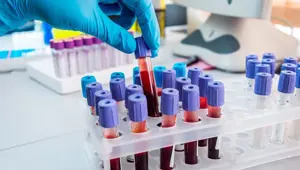 Karaciğer kanserine kanla erken teşhis Karaciğer kanserine kanla erken teşhis