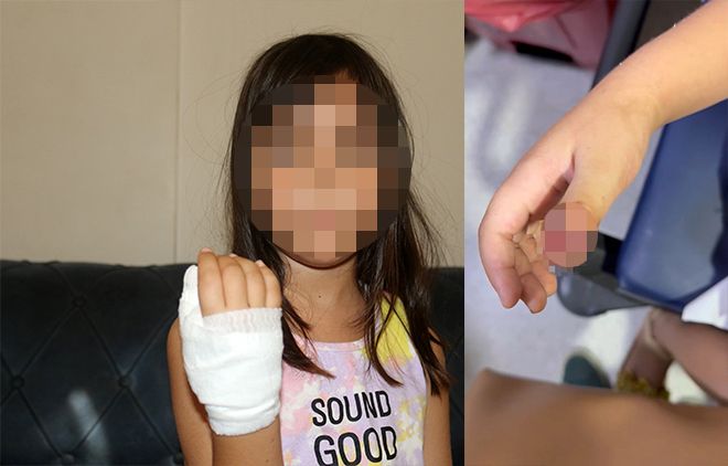 Anaokulunda korkunç olay: Dört yaşındaki çocuğun parmağı koptu