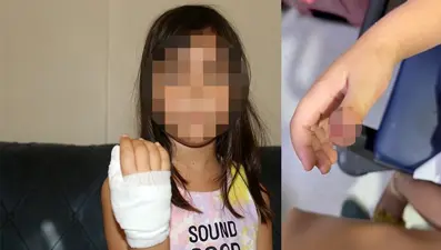 Anaokulunda korkunç olay: Dört yaşındaki çocuğun parmağı koptu