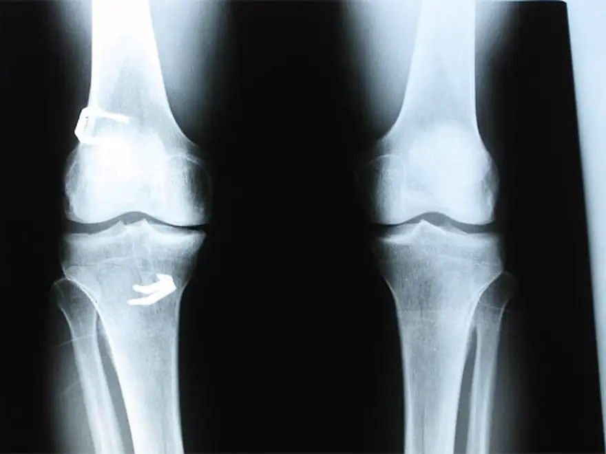 Genuphobia: Diz korkusu 2 Genuphobia: Diz korkusu 2