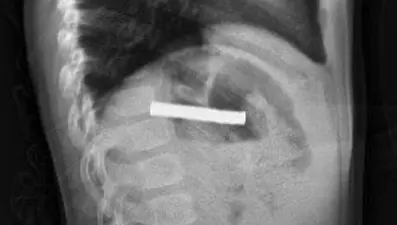 Boğazından 19 adet mıknatıs çıkartıldı