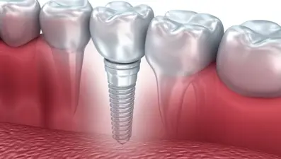 Uzmanlardan merdivenaltı diş implantı uyarısı