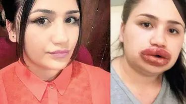 Dudak dolgusu yaptıran hemşire dudaklarını kaybedebilir