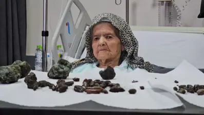 92 yaşındaki kadının midesinden ve bağırsaklarından çıktı: Kaç senedir yiyordum, zarar vereceğini düşünmedim