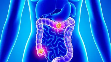 Bağırsakta polip oluşumunun 8 nedeni