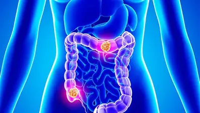 Bağırsakta polip oluşumunun 8 nedeni