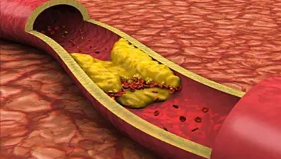 Kolesterol yüksekliği neden olur?.. İyi-kötü kolesterol nedir? (HDL-LDL nedir, iyi-kötü kolesterol farkı)