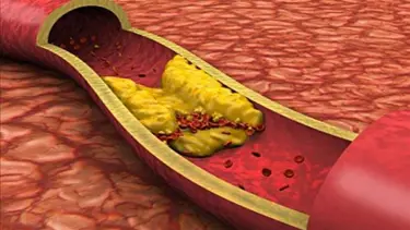 Kolesterol yüksekliği neden olur?.. İyi-kötü kolesterol nedir? (HDL-LDL nedir, iyi-kötü kolesterol farkı)