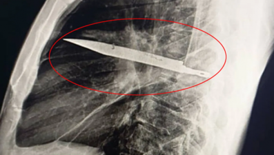 Ağrı şikayetiyle gitti, göğsünden bıçak çıktı: 8 yıl birlikte yaşamış