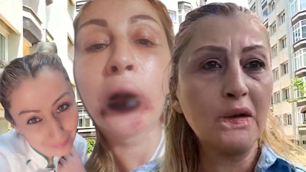 Dolgu yaptırdığı dudağı çürüdü. "Ana damarlarım çürümüş, gülüşüm yok, yemek yiyemiyorum"