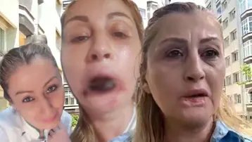 Dolgu yaptırdığı dudağı çürüdü. "Ana damarlarım çürümüş, gülüşüm yok, yemek yiyemiyorum"