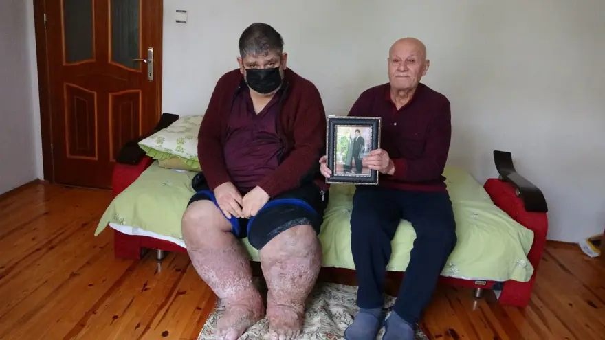 Sivrisinek ısırığı hayatını kararttı 1 Sivrisinek ısırığı hayatını kararttı 1