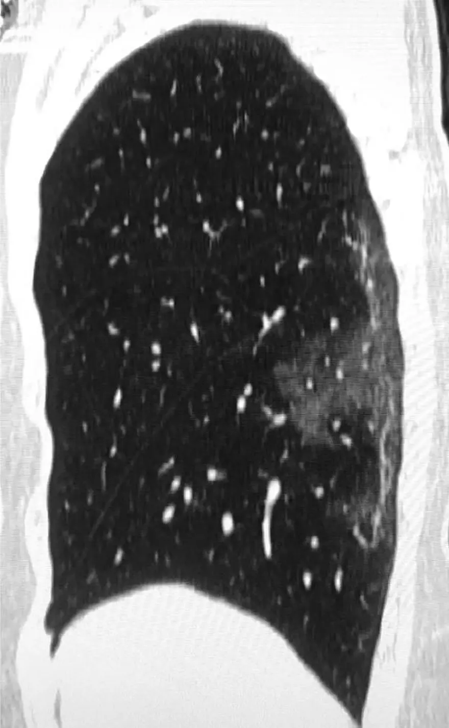 44yaşında corona virüsten hayatını kaybeden kişinin  akciğer röntgen filmleri virüsün verdiği zararıortaya çıkardı 3